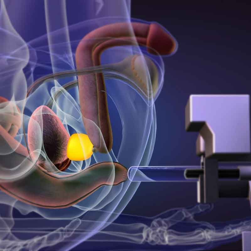 3D render image showing robotic biopsy for prostate