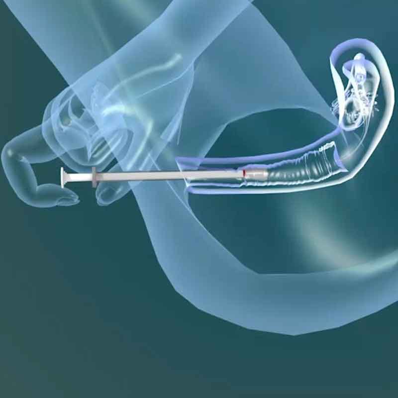 3D render image of using vaginal eastrogen cream with applicator