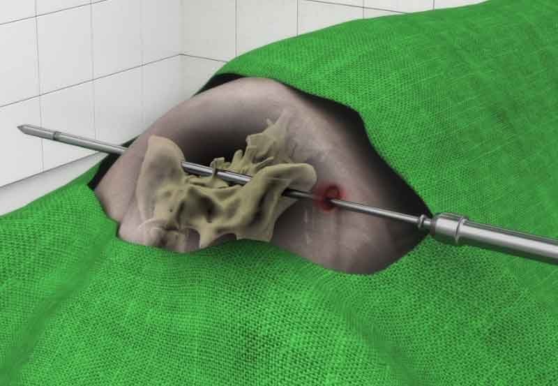 A still render from degenerative lumbosacral stenosis surgery