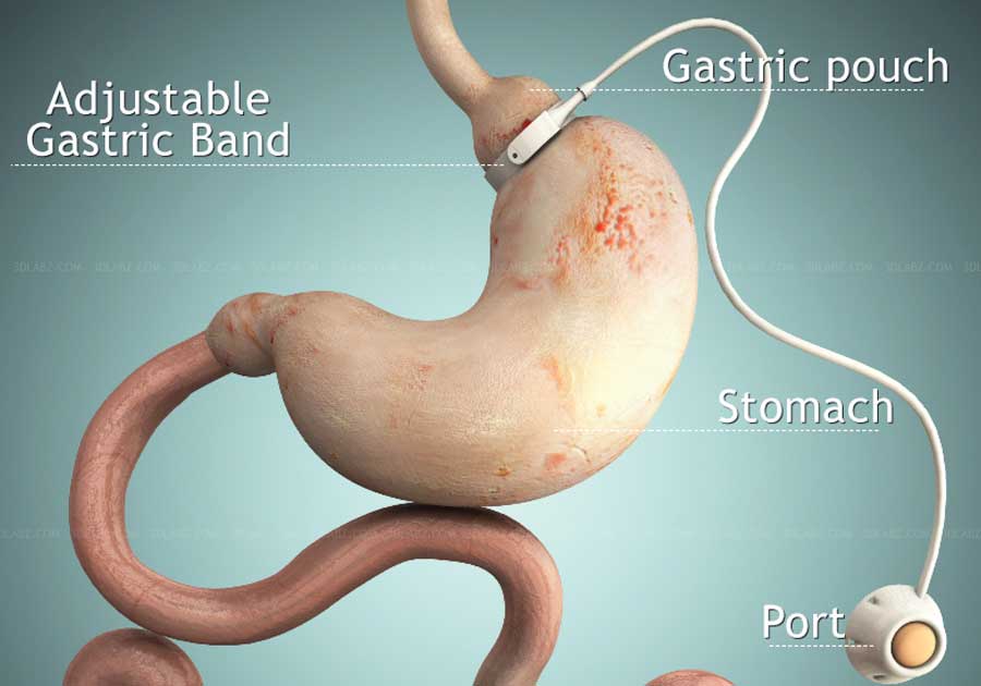 Medical illustration Adjustable Gastric band