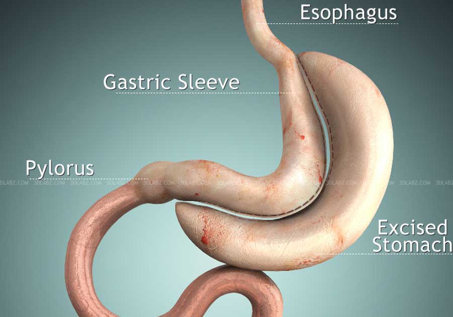 Vertical Sleeve Gastrectomy 3D Illustration