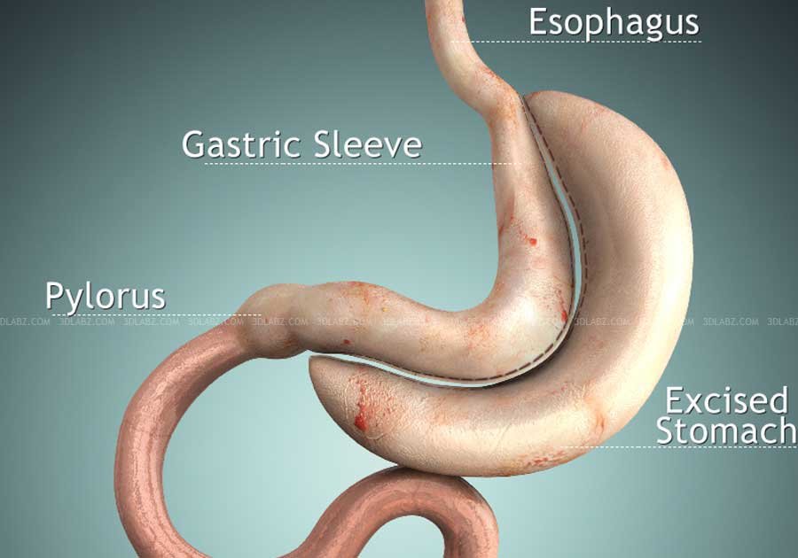 Vertical Sleeve Gastrectomy